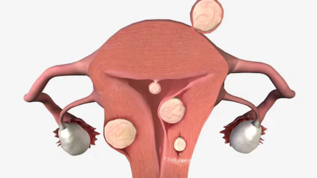 ovarian cyst cancer treatment